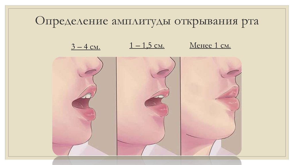 Контрактура нижней. Степень открывания рта. Степень открывания рта в норме. Ограничение открывания рта степени. Оценка степени открывания рта.