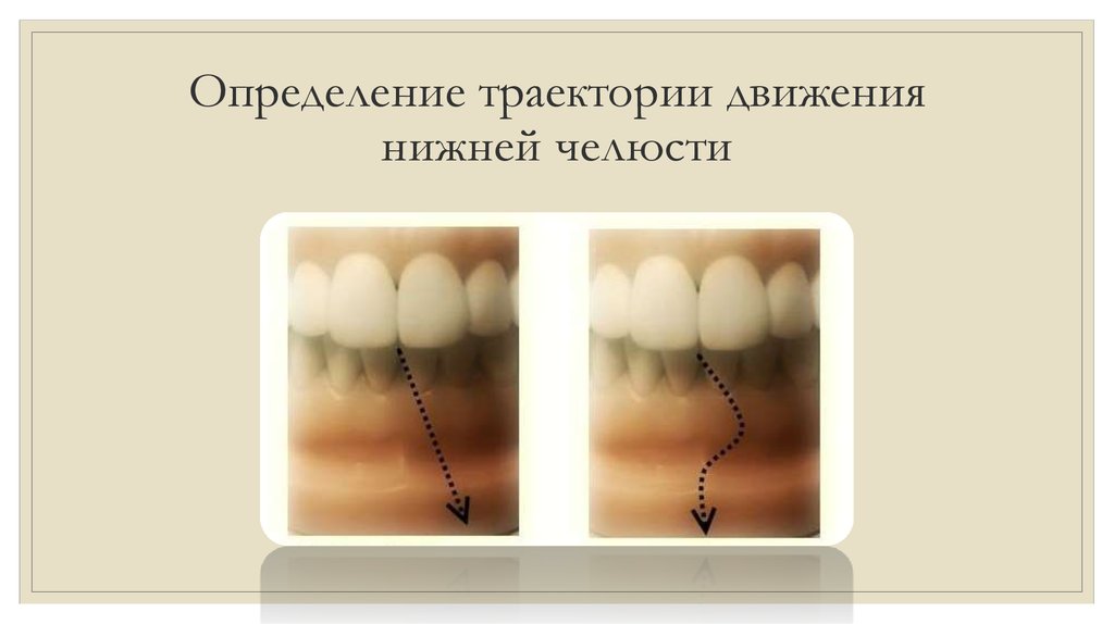Определение траектории движения нижней челюсти