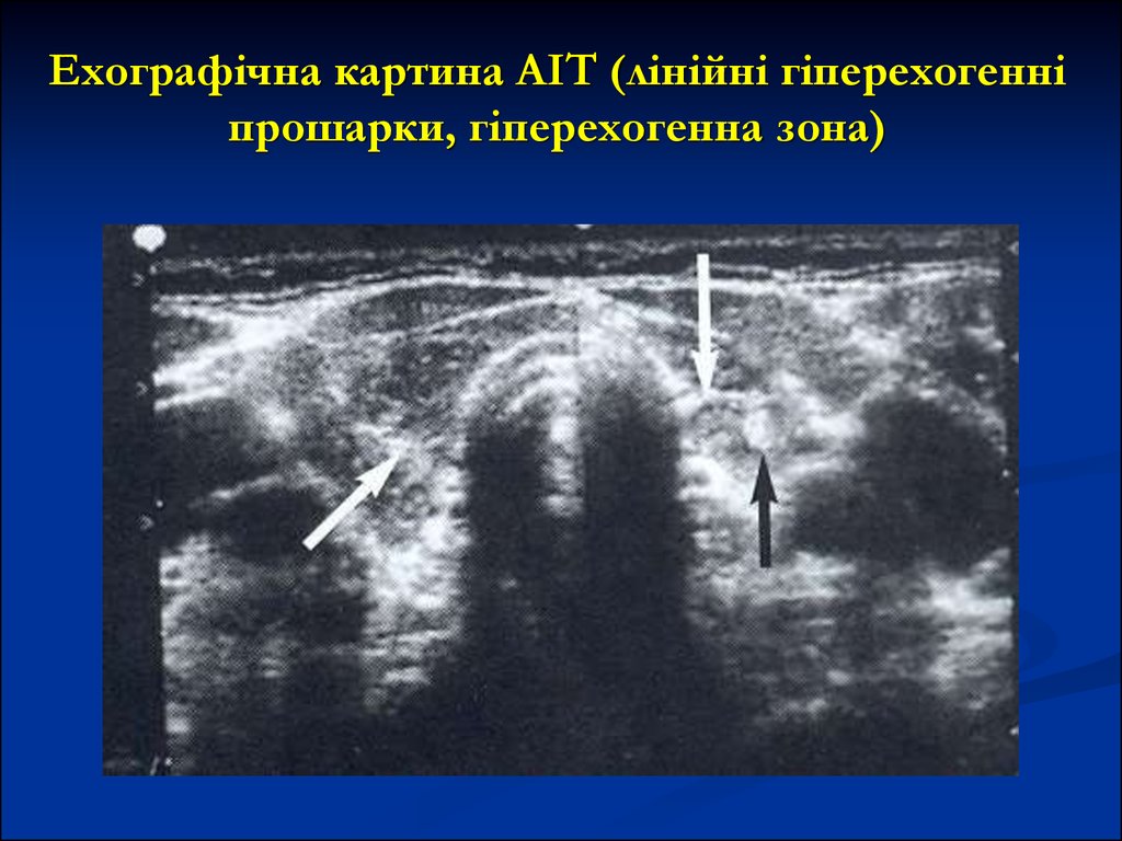 Для эхографической картины острого холецистита характерно