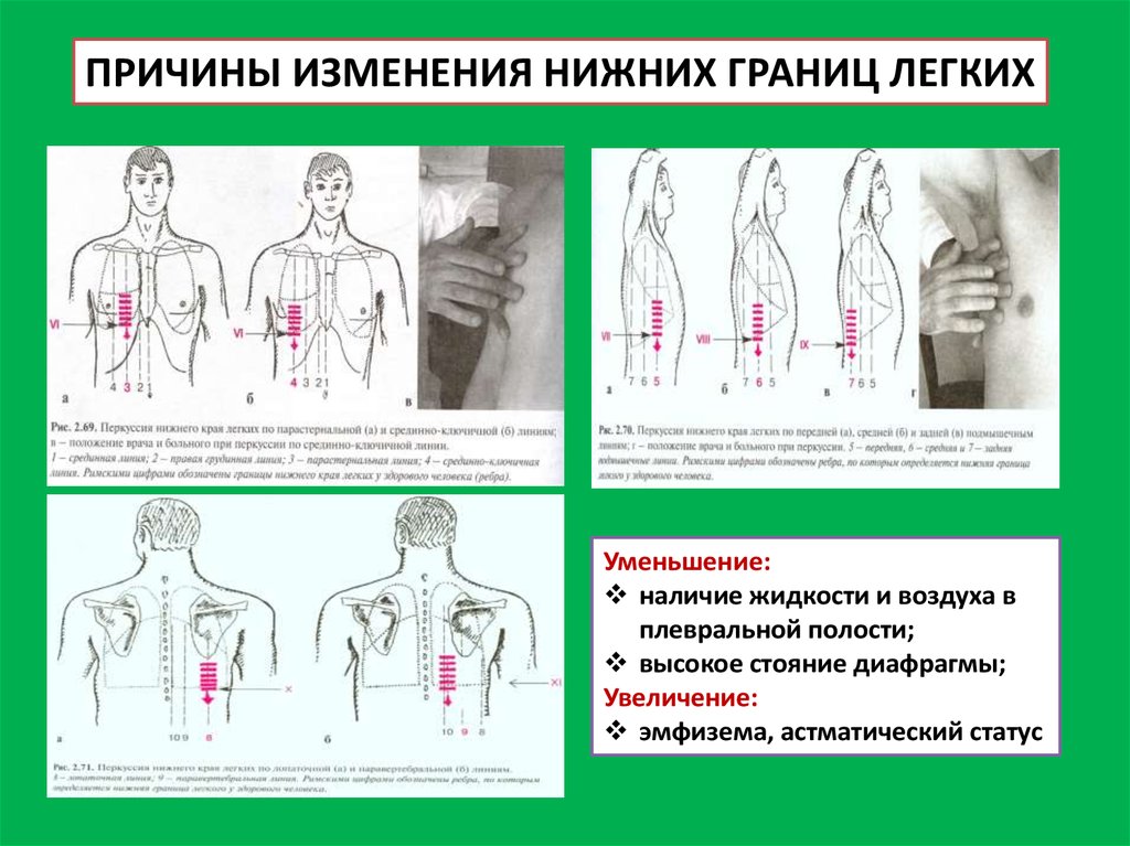 Границы легких в норме при перкуссии