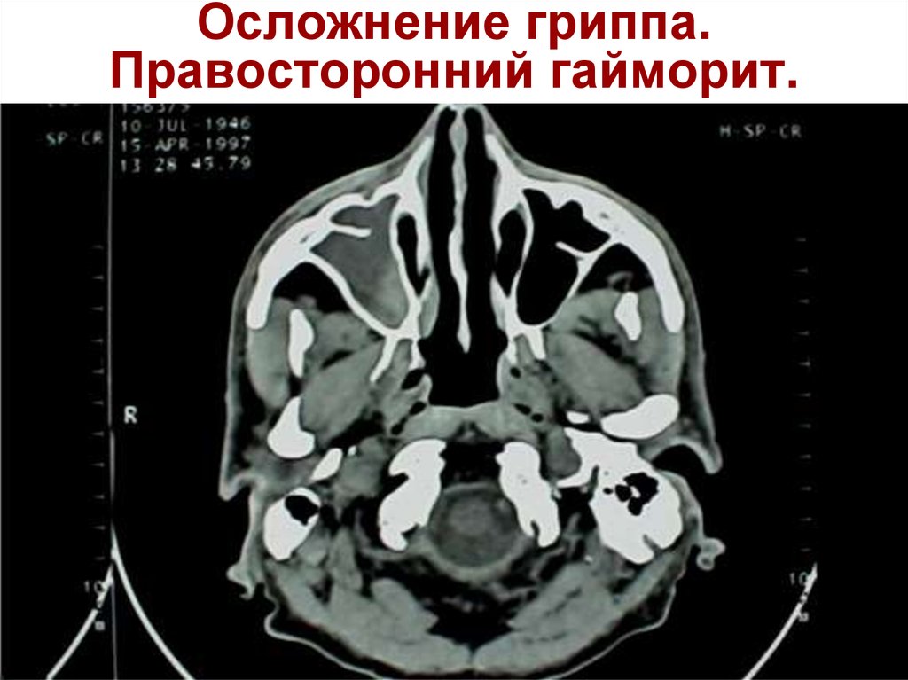 Осложнения синусита. Правосторонний гайморит. Правосторонний синусит. Острый правосторонний гайморит. Правосторонний катаральный гайморит.