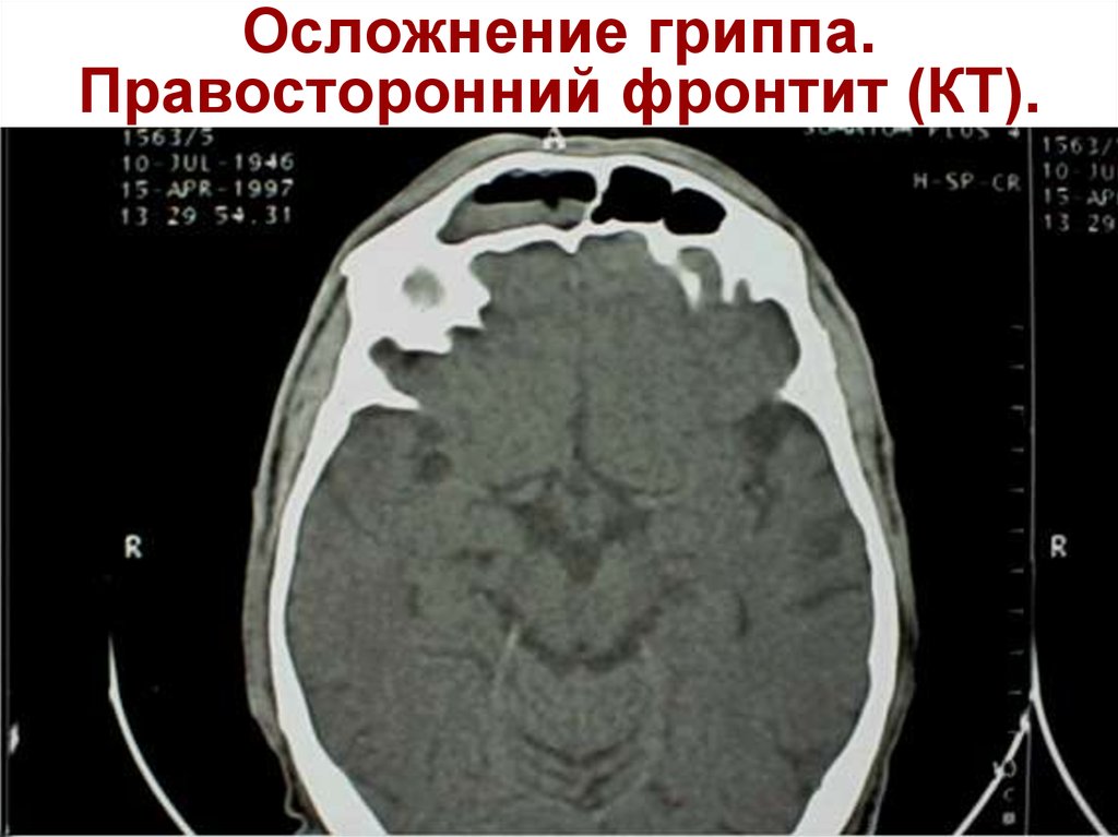 Фронтит осложнения. Правосторонний фронтит кт. Правосторонний полисинусит кт. Правосторонний гайморофронтит.