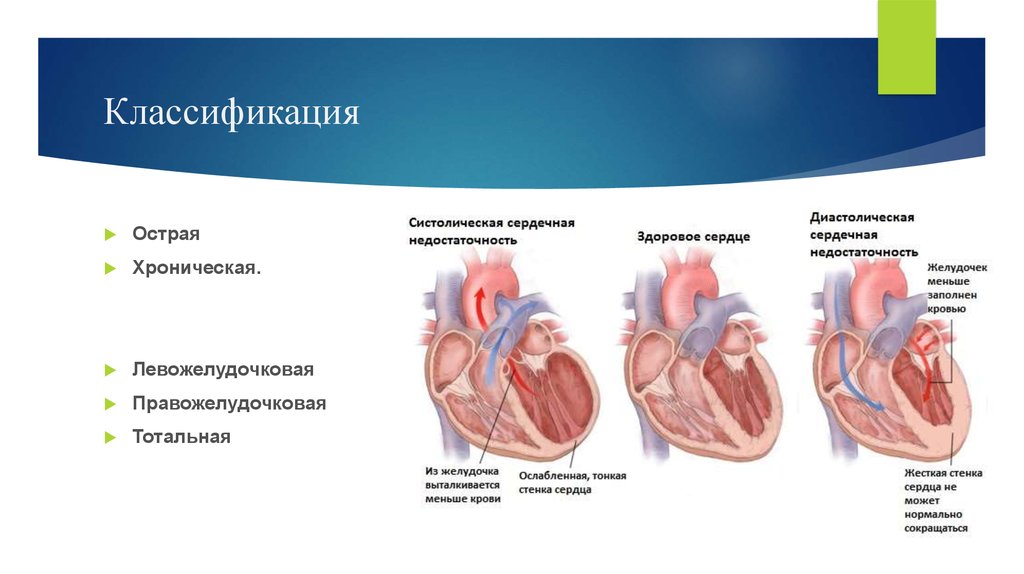 Классификация сердечно. Острая и хроническая сердечная недостаточность классификация. Хроническая правожелудочковая недостаточность классификация. Левожелудочковая сердечная недостаточность. ХСН. Острая сердечная недостаточность левожелудочковая классификация.