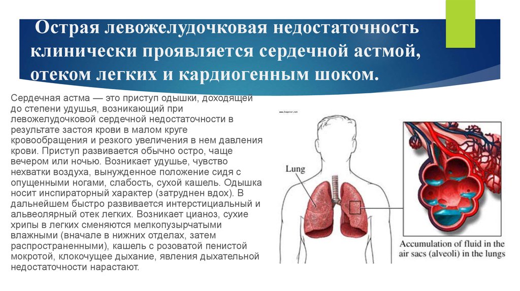 Острая левожелудочковая недостаточность клинически проявляется сердечной астмой, отеком легких и кардиогенным шоком.