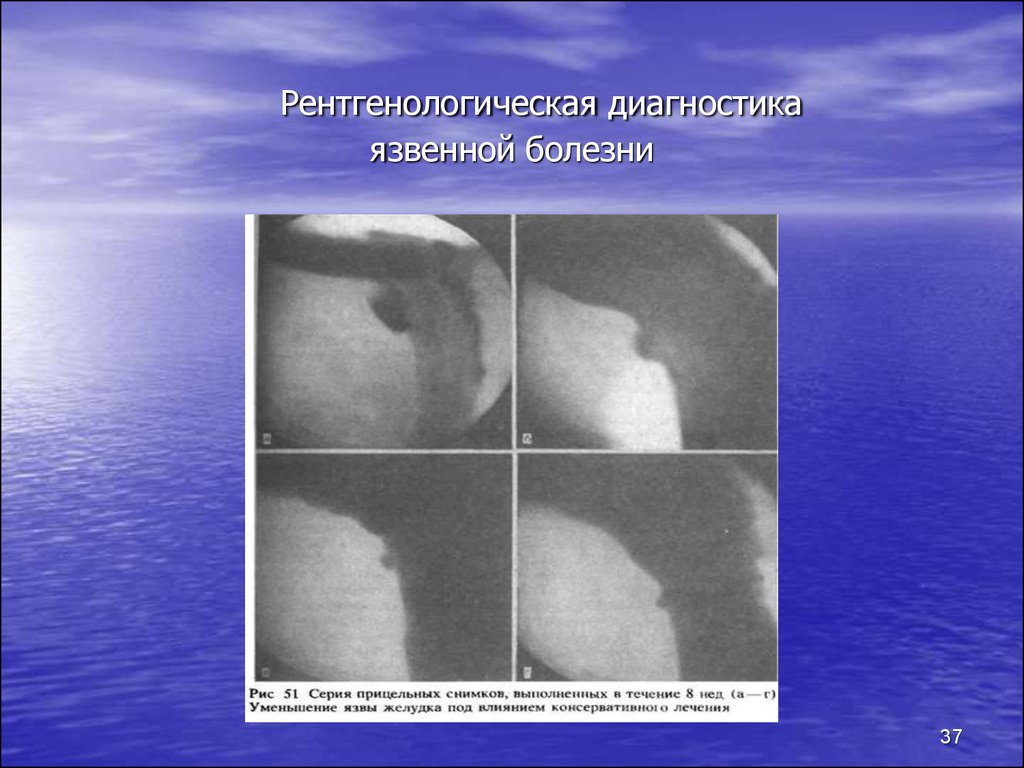 Диагностика язвы. Диагностика язвенной болезни. Язвенная болезнь диагностика лечение. Рентгенологическая болезнь.