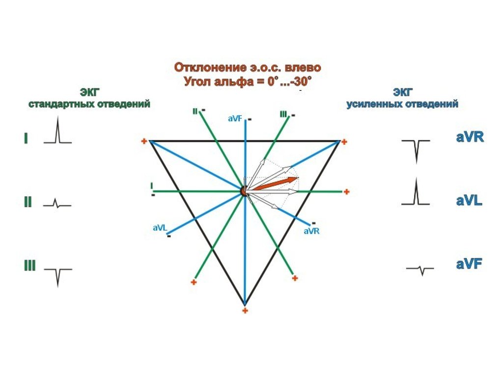 Угол альфа. Электрическая ось сердца угол Альфа. Электрическая ось сердца отведения. Ось сердца на ЭКГ угол Альфа. Угол Альфа отклонение ЭОС.