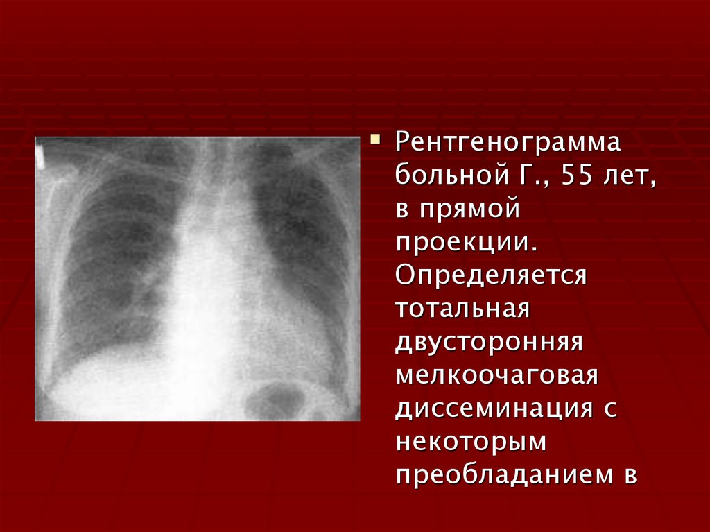 Макроскопическая картина легкого при фиброзирующих альвеолитах