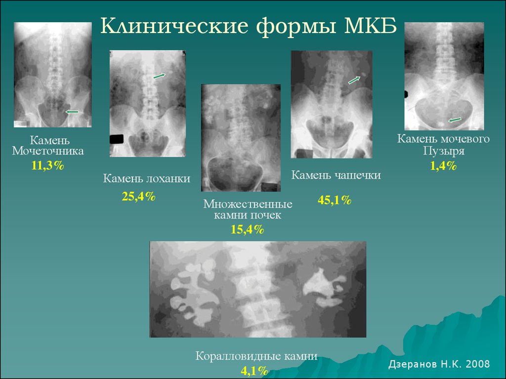 Камни в почках код