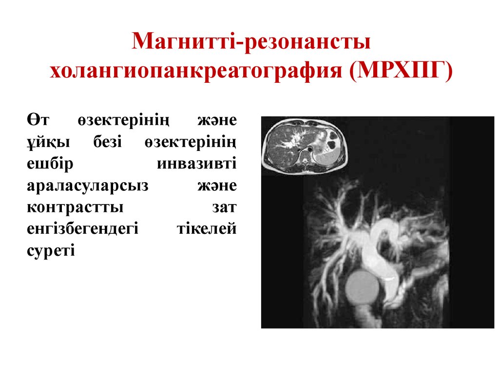 Мрхпг. Холангиопанкреатография МРХПГ. Магнито резонансная холангиопанкреатография. Холангиопанкреатография мрт. Мрт брюшной полости МРХПГ.