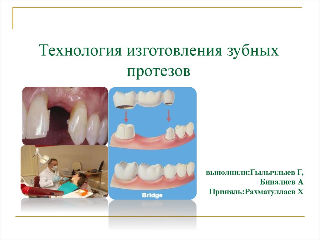 Изготовление мостовидных протезов презентация
