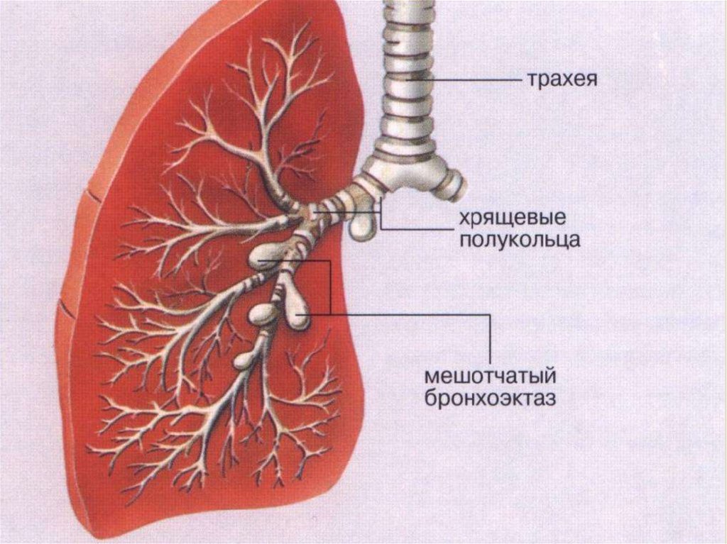 Бронхоэктатическая болезнь презентация