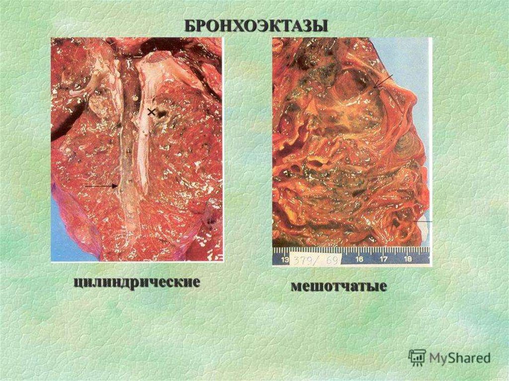 Бронхоэктатическая болезнь презентация