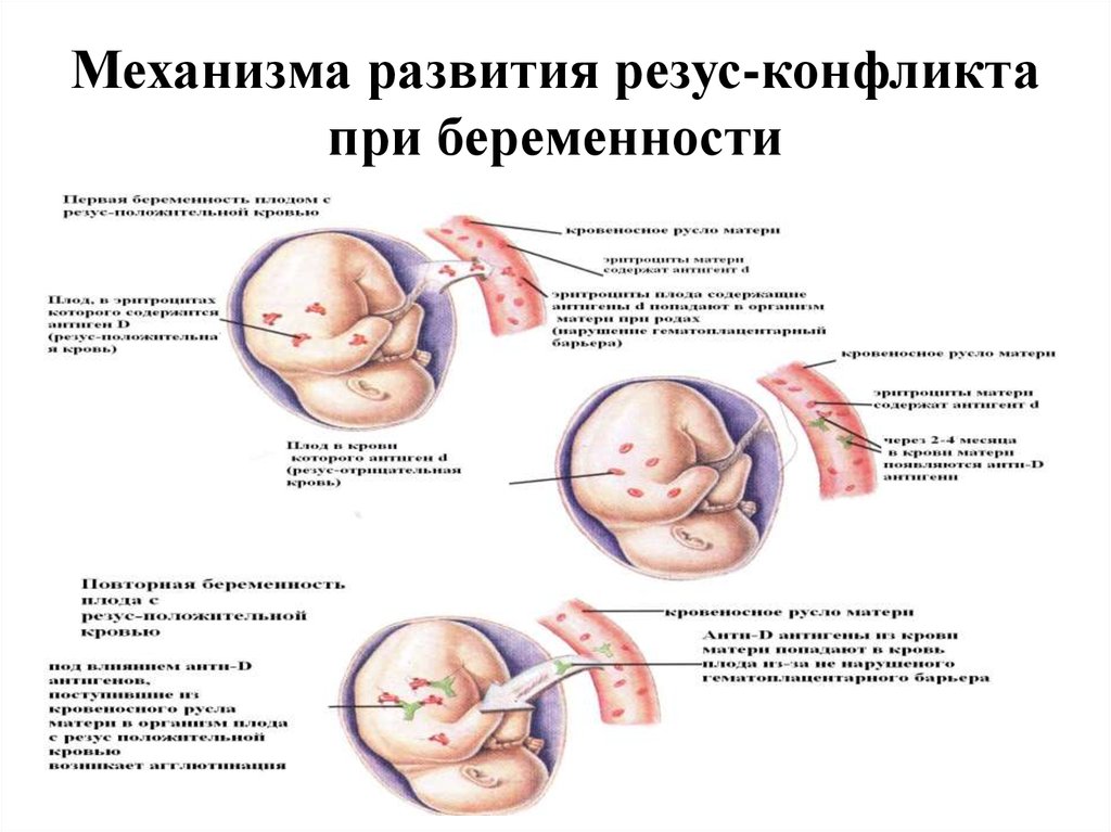 Механизма развития резус-конфликта при беременности