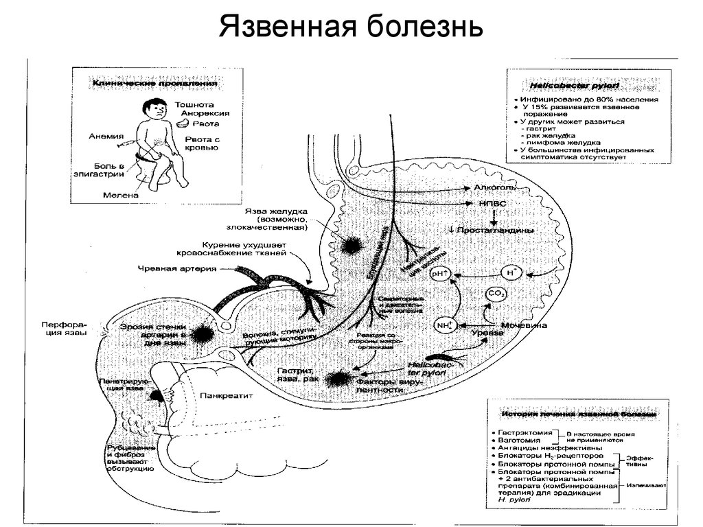 Клинические рекомендации язвенная болезнь 2023