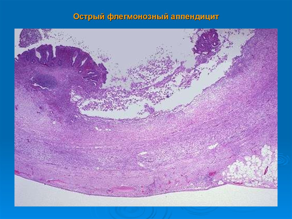 Флегмонозный аппендицит микропрепарат рисунок