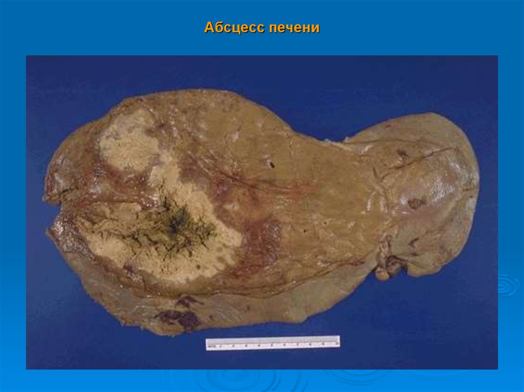 Абсцесс печени