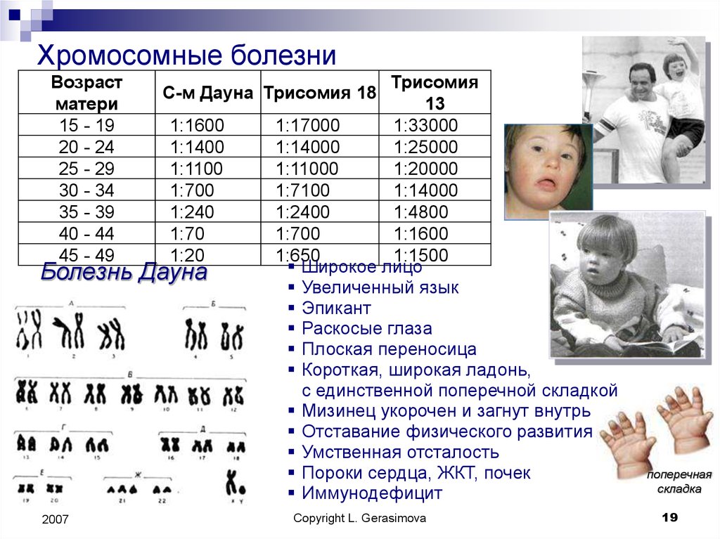 Хромосомные заболевания дауна. Синдром Дауна хромосомная патология. Распространенность синдрома Дауна. Болезнь Дауна трисомия. Хромосомные болезни хромосомы.