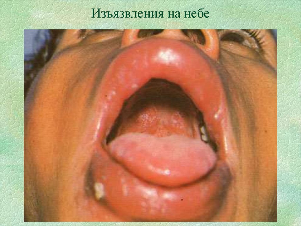 Изъязвления на небе