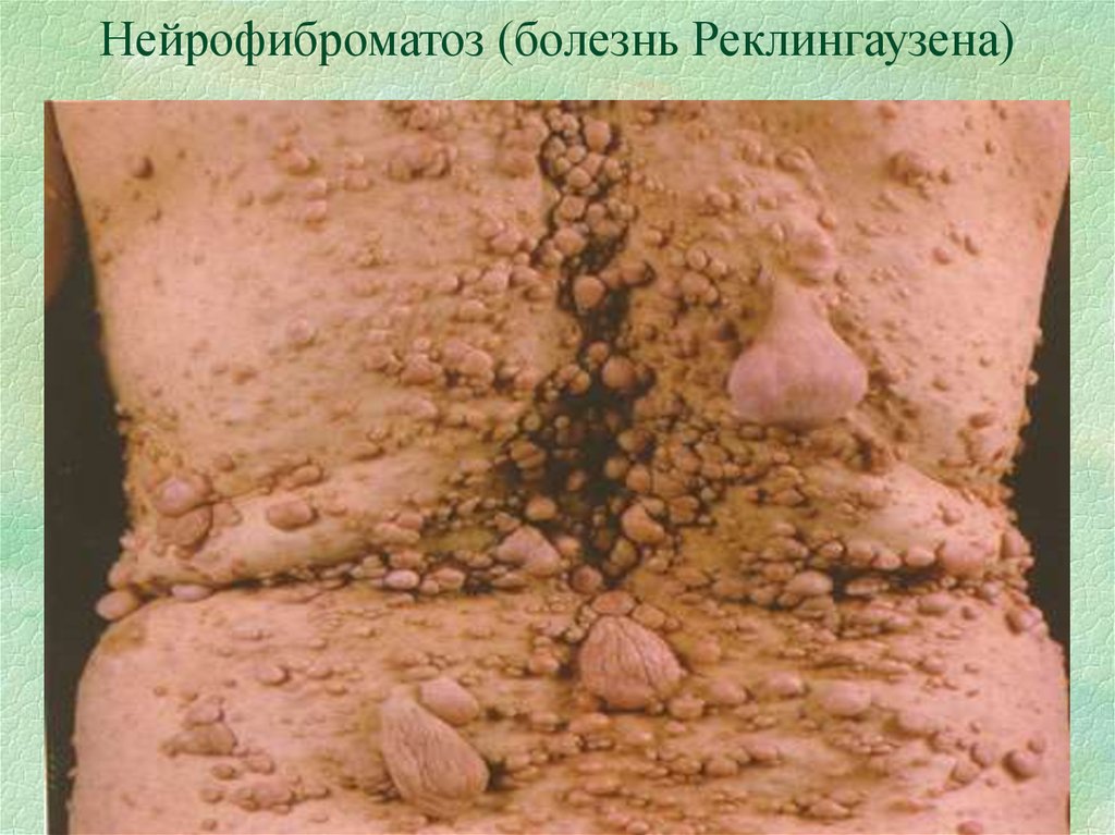 Нейрофиброматоз (болезнь Реклингаузена)
