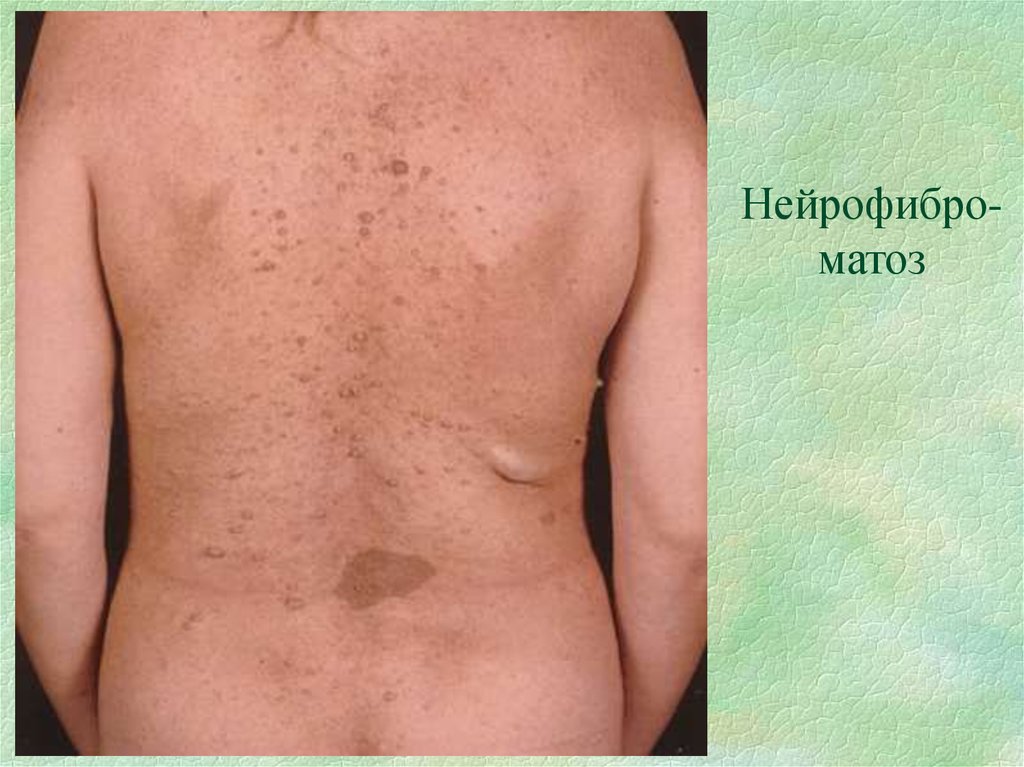 Нейрофибро- матоз