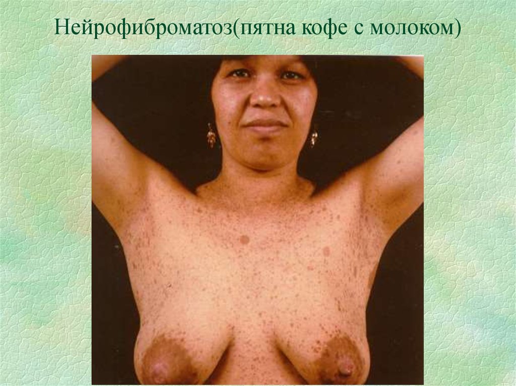 Нейрофиброматоз(пятна кофе с молоком)