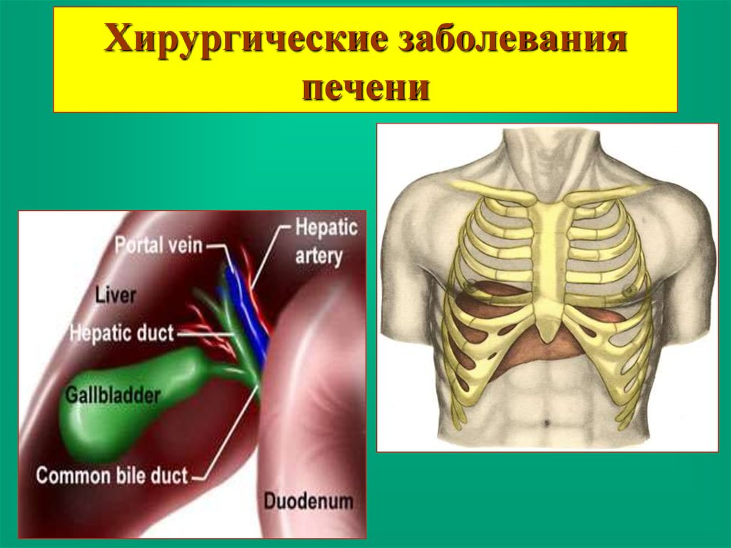 Заболевания печени хирургия презентация