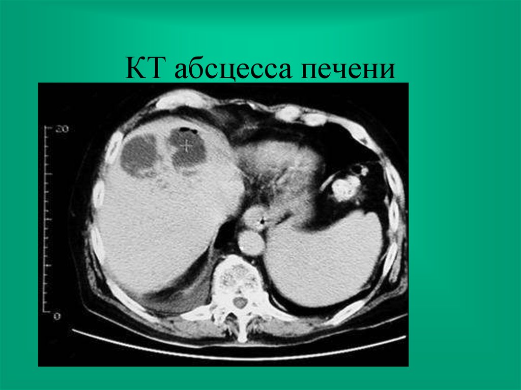 Абсцессы печени презентация