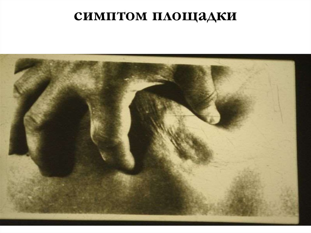 симптом площадки