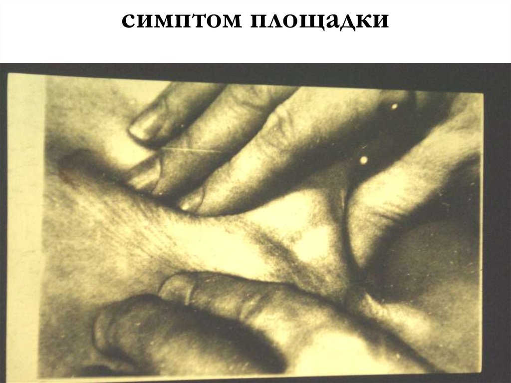 симптом площадки