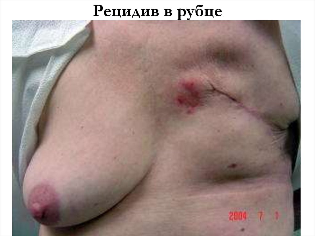 Рецидив в рубце