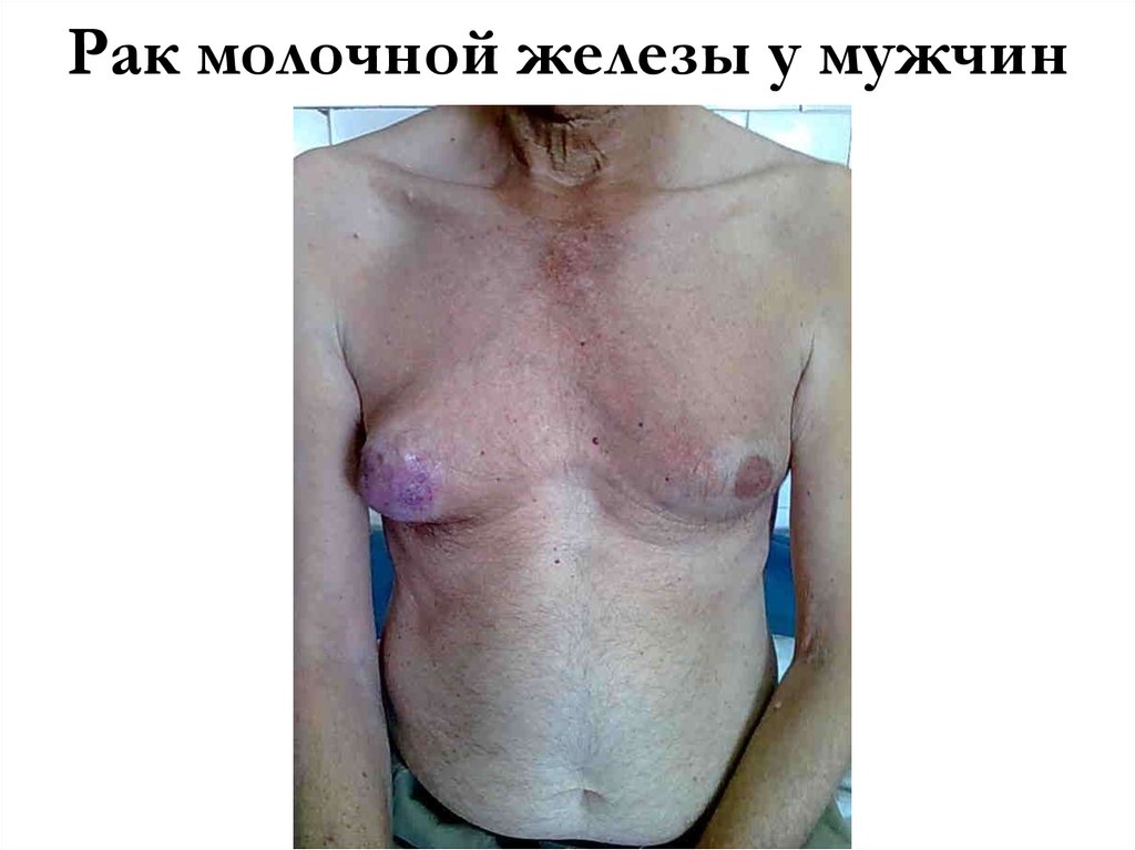 Рак молочной железы у мужчин