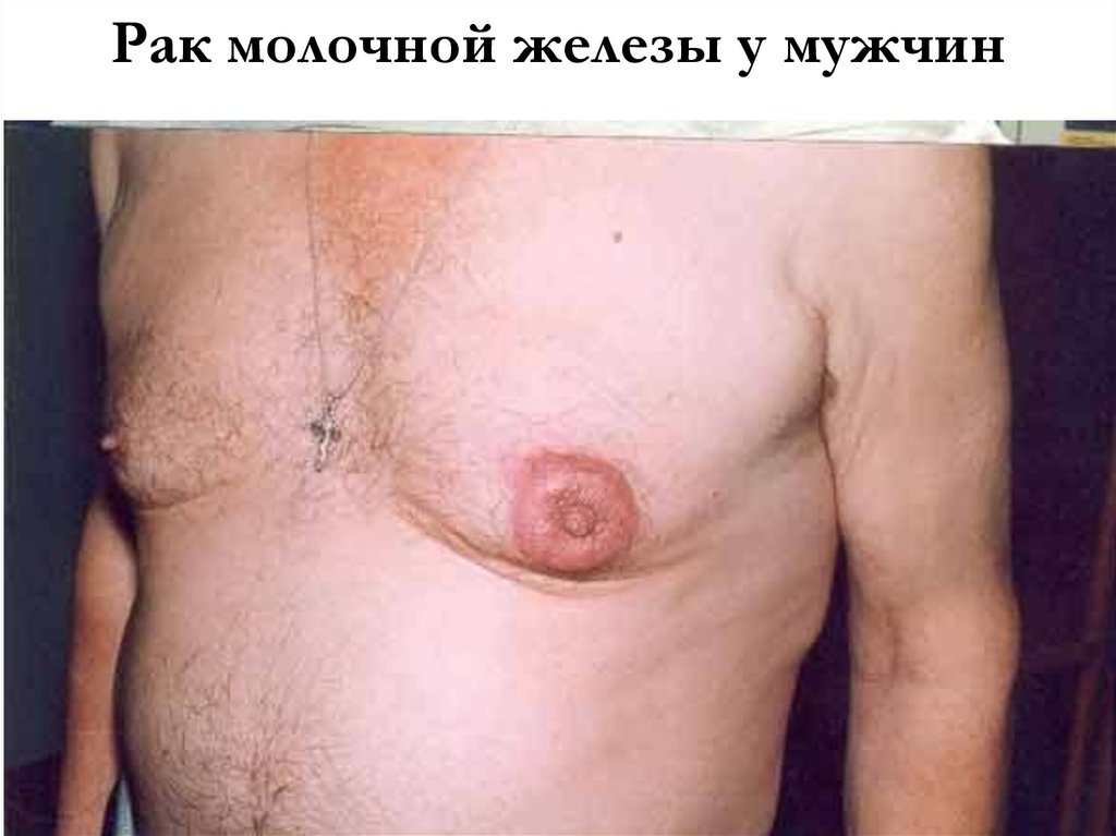 Рак молочной железы у мужчин