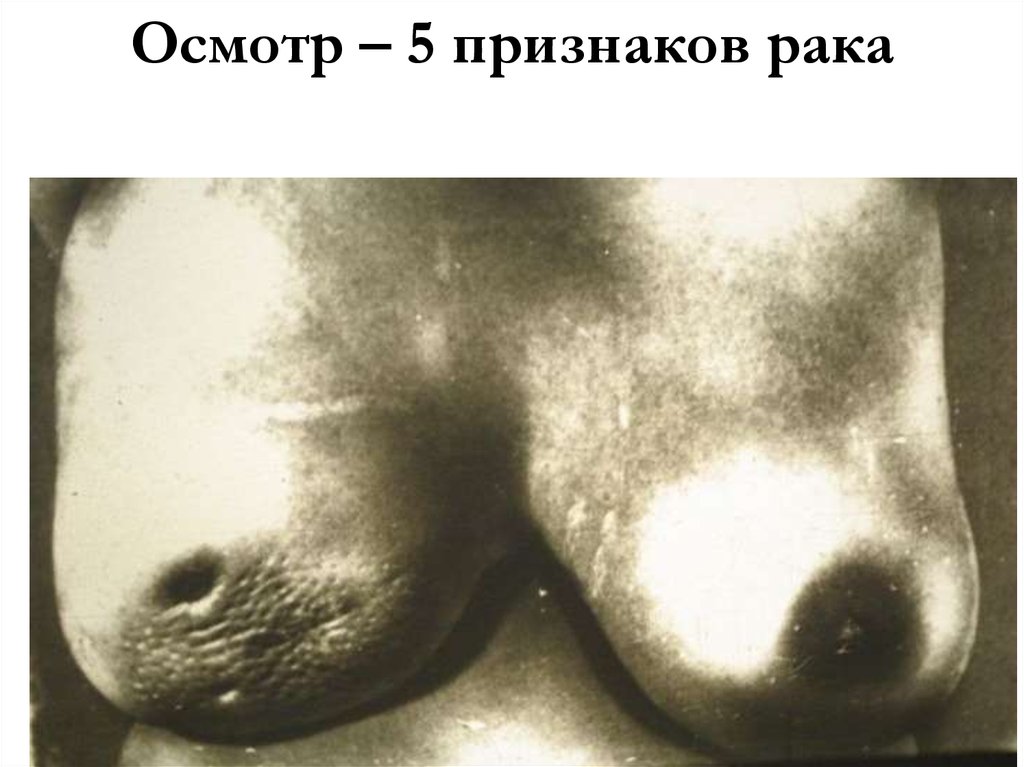 Осмотр – 5 признаков рака