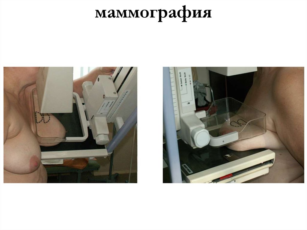 маммография