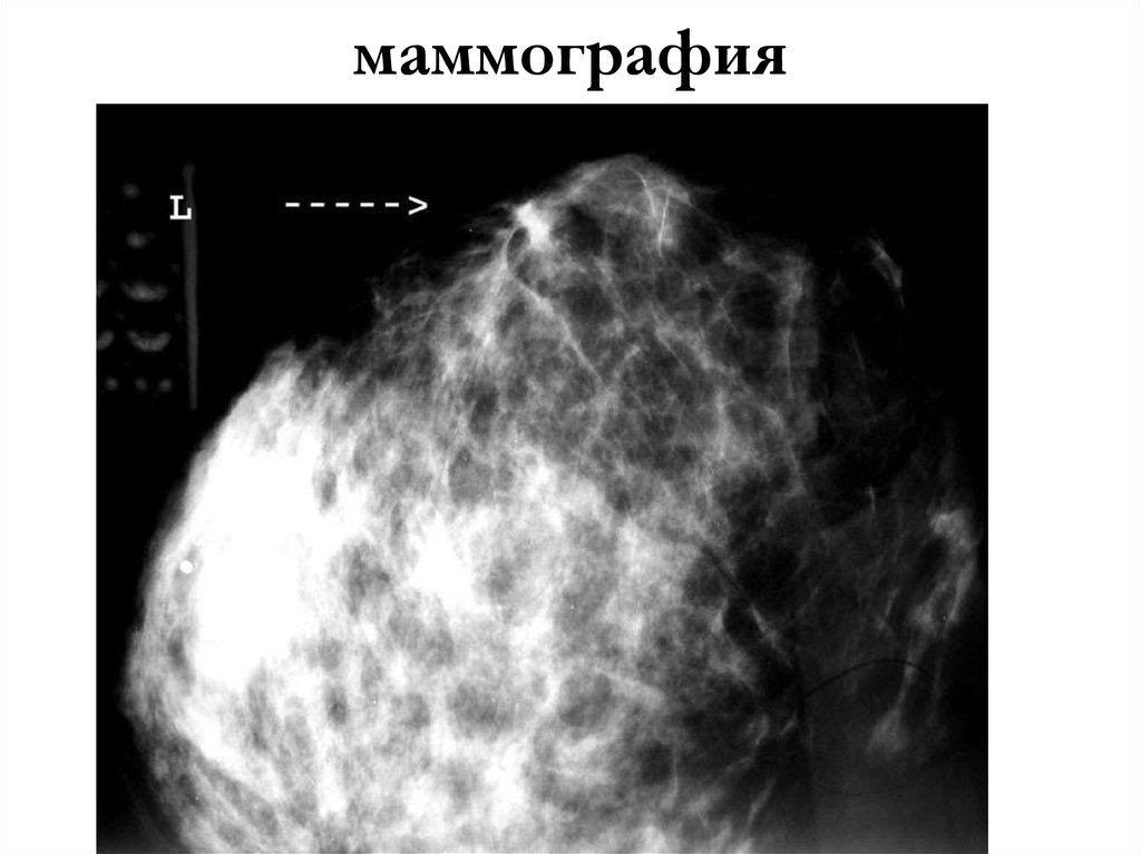 Аденоз на маммографии. Аденоз маммография снимки. Маммография снимок в норме.