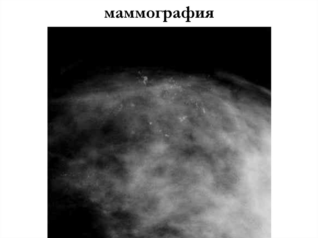 маммография