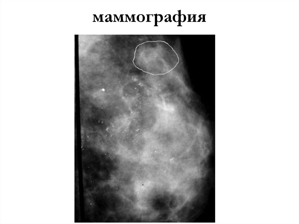 маммография