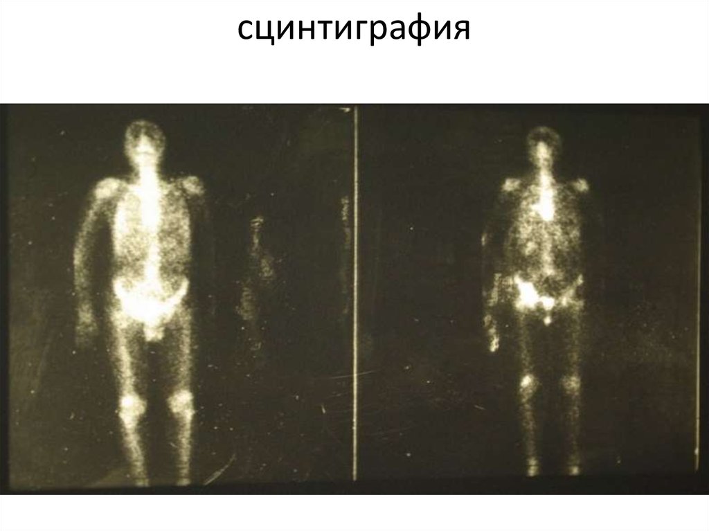 сцинтиграфия
