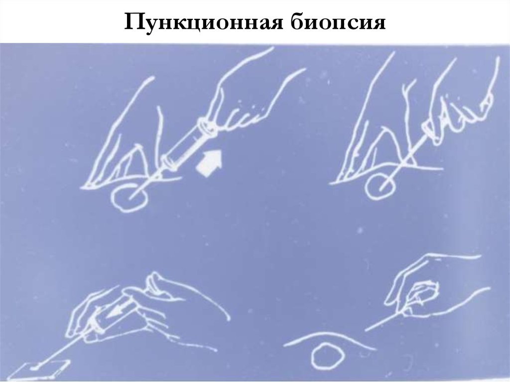 Пункционная биопсия