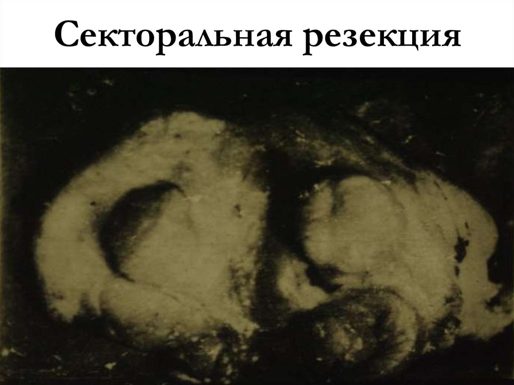 Секторальная резекция