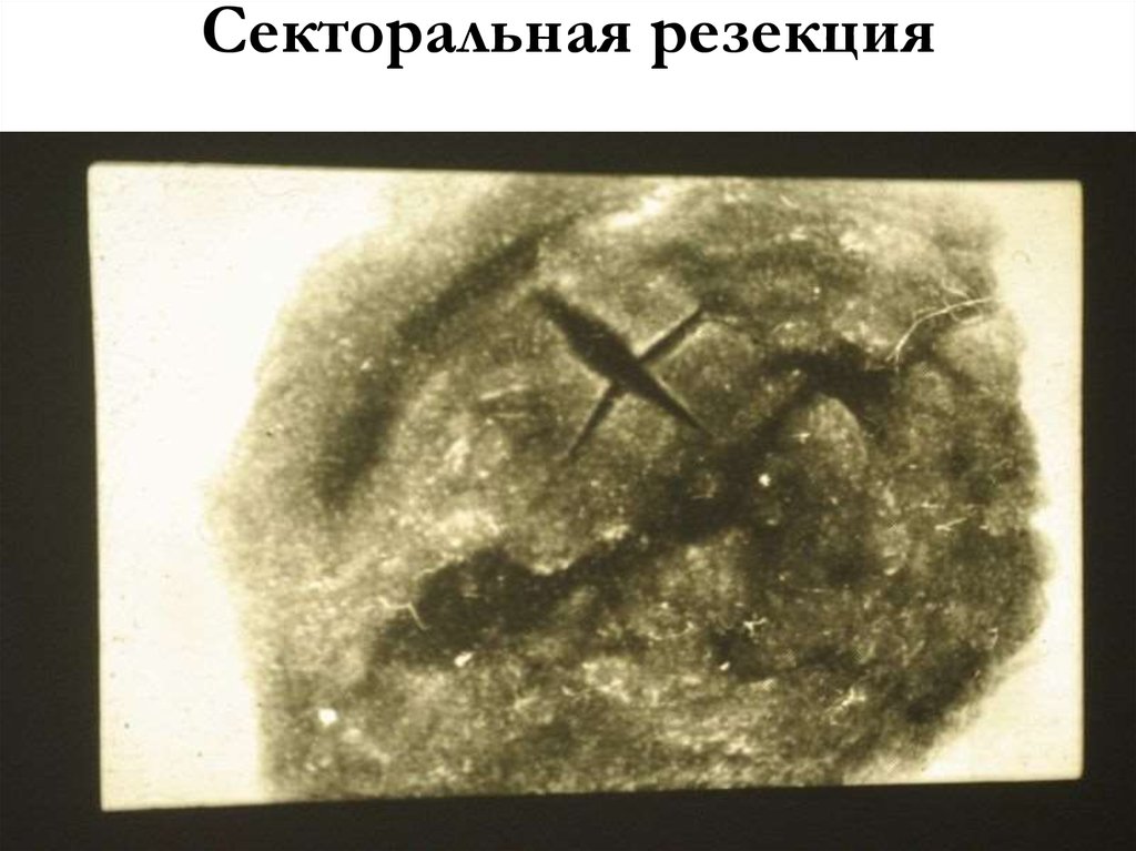 Секторальная резекция