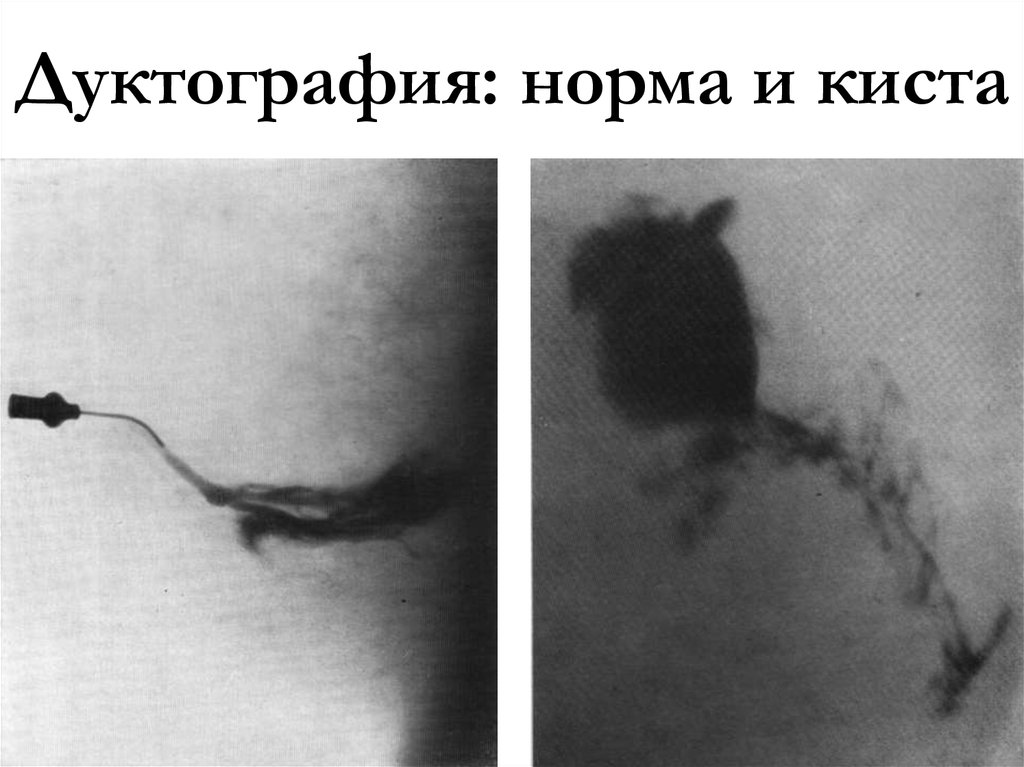 Дуктография: норма и киста