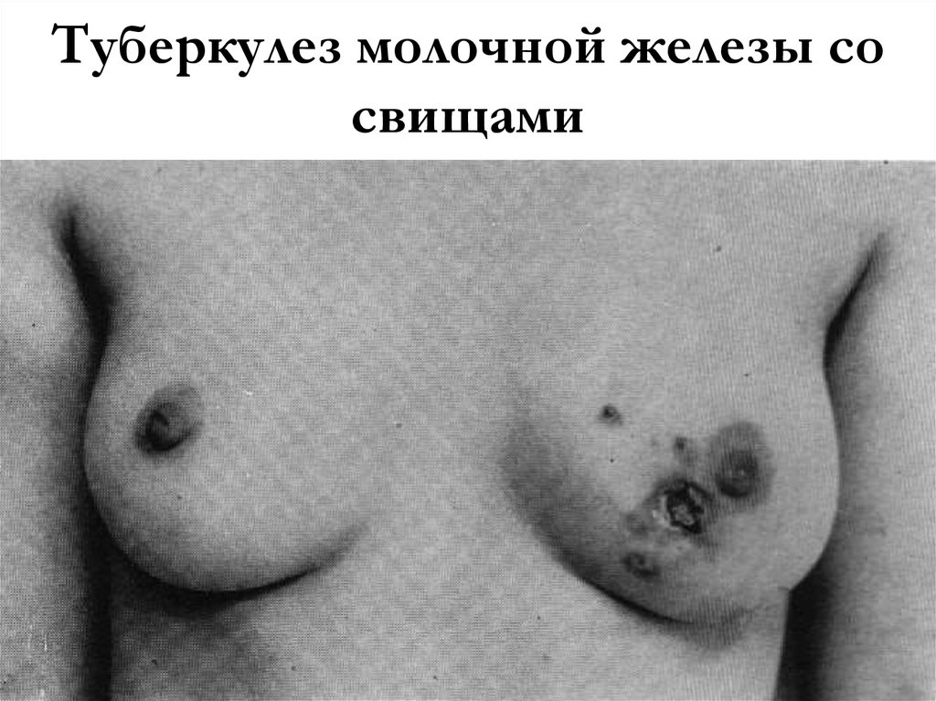 Туберкулез молочной железы со свищами