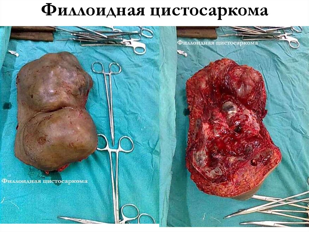 Филлоидная цистосаркома