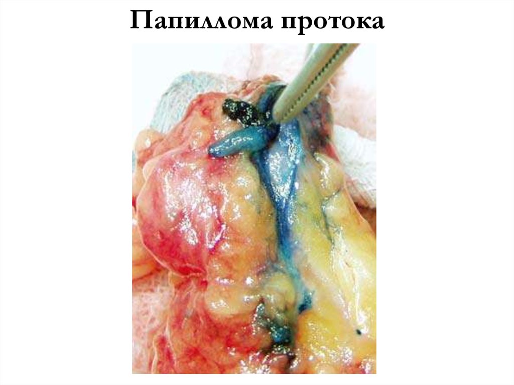 Папиллома протока