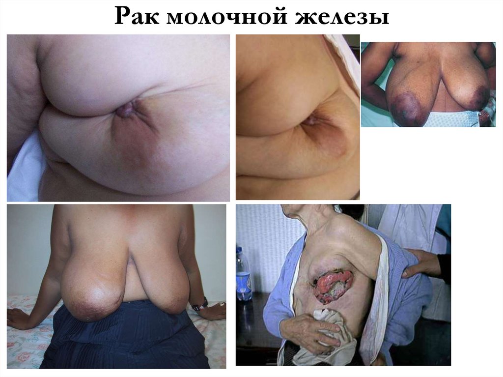 Рак молочной железы