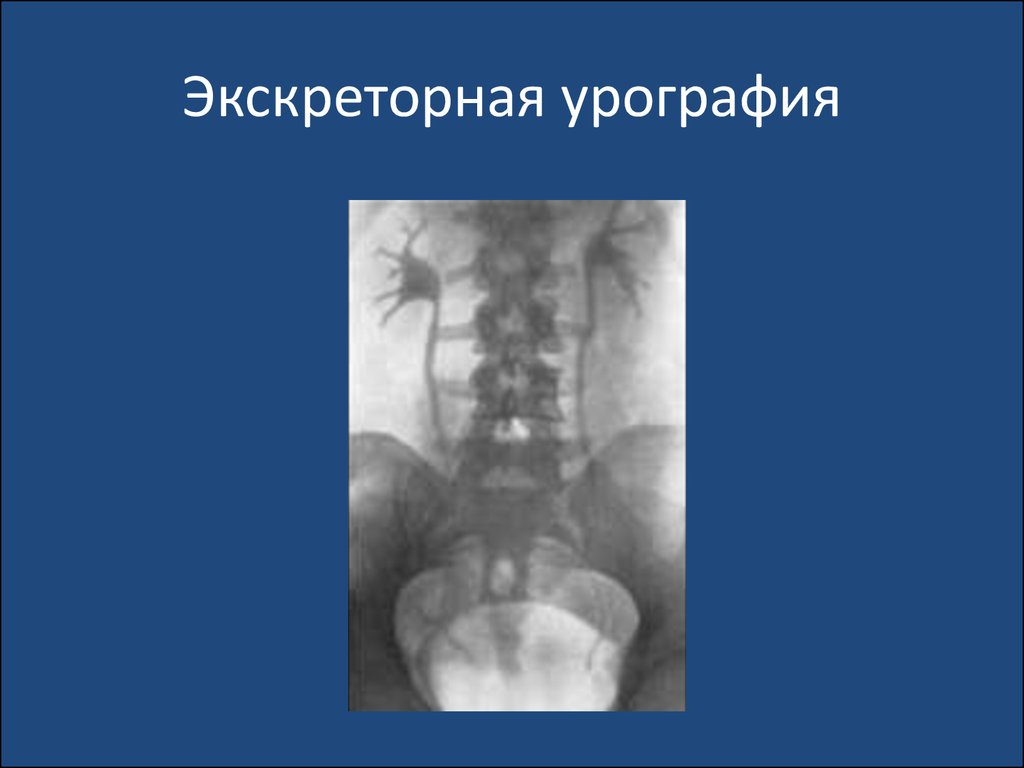 Экскреторная урография. Внутривенная урография нефросклероз. Туболоинстрецианальный нефрит экскреторная урография. Экскреторная урография лежа и стоя. Омнипак для экскреторной урографии.