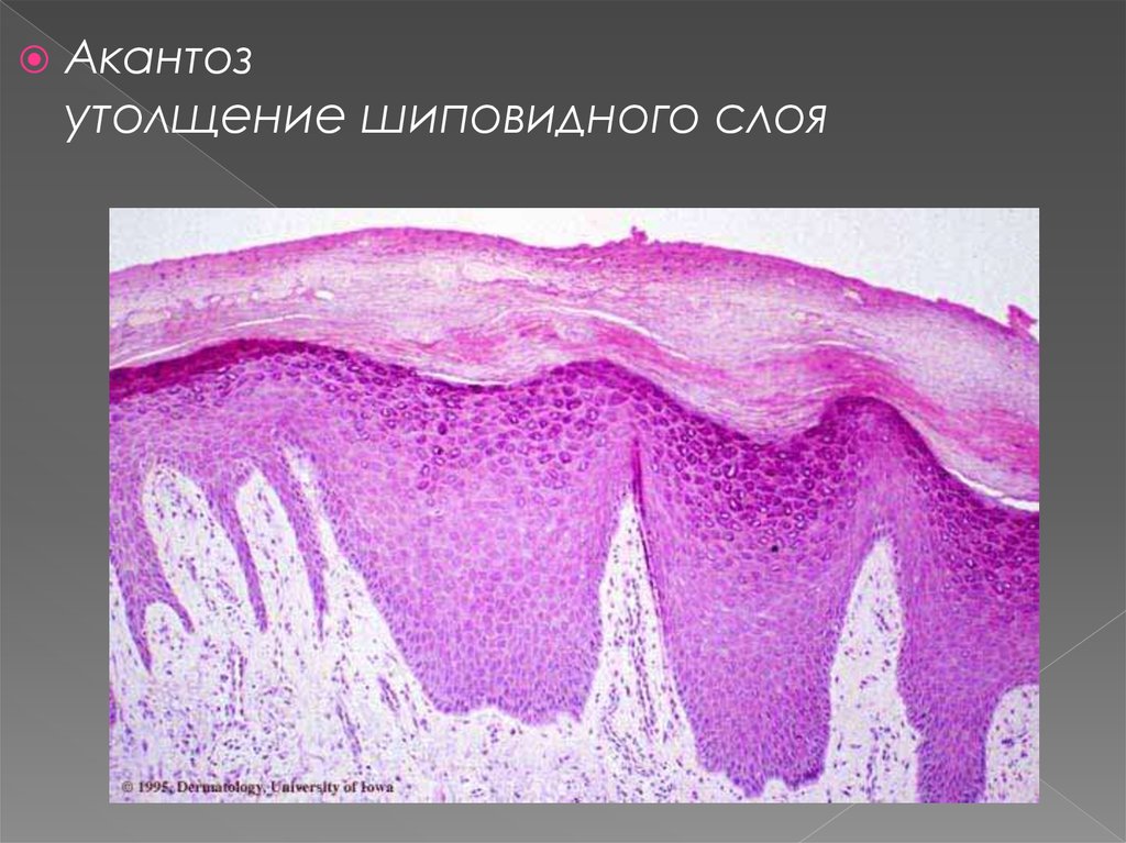 Увеличение слой. Акантоз гистология псориаз. Акантоз кожи гистология. Паракератоз гистология.