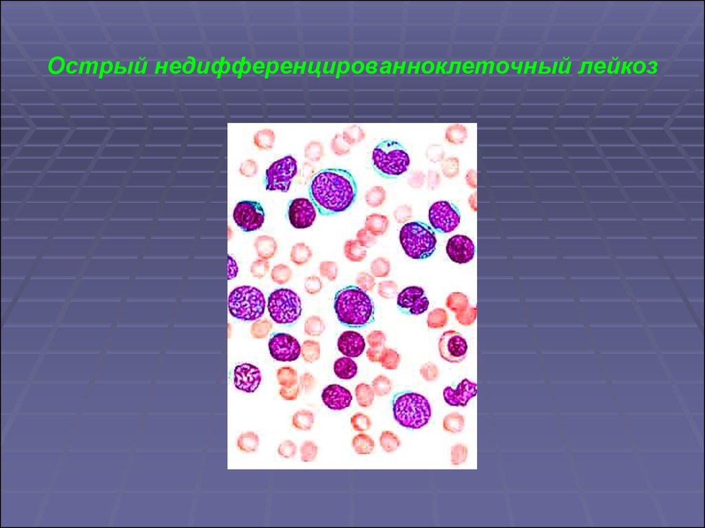 Недифференцированный лейкоз. Острый недифференцированный лейкоз. Острый недифференцированный лейкоз картина крови. Недифференцированный острый миелолейкоз. Острый недифференцированный АЛЕЙКЕМИЧЕСКИЙ лейкоз.