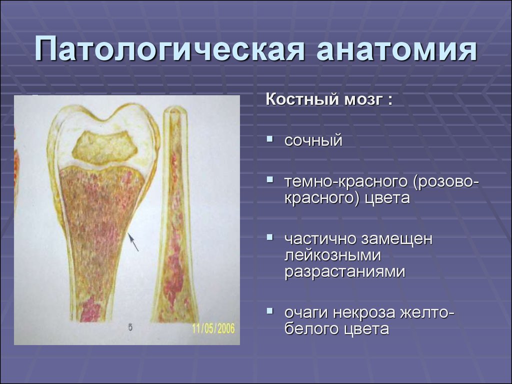 Патологическая анатомия это. Еостный мозг ПАТ анатомия. Лейкоз патологическая анатомия. Патанатомия костного мозга. Лейкоз патоморфология.